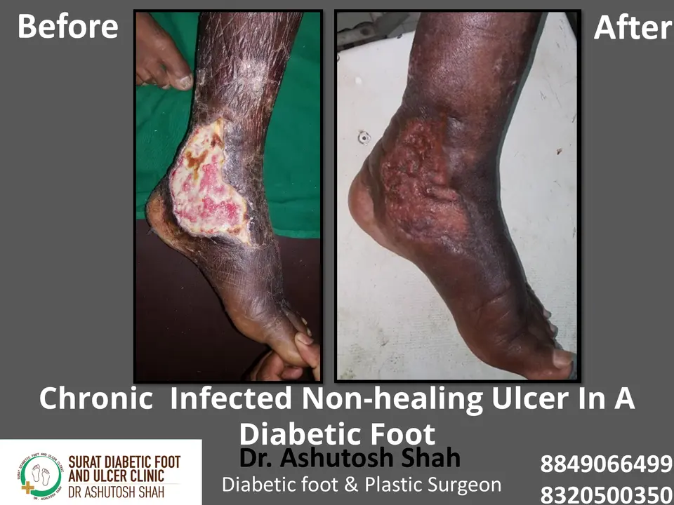 Diabetic Foot  PPT 3 checked by sir.pptx-63.webp